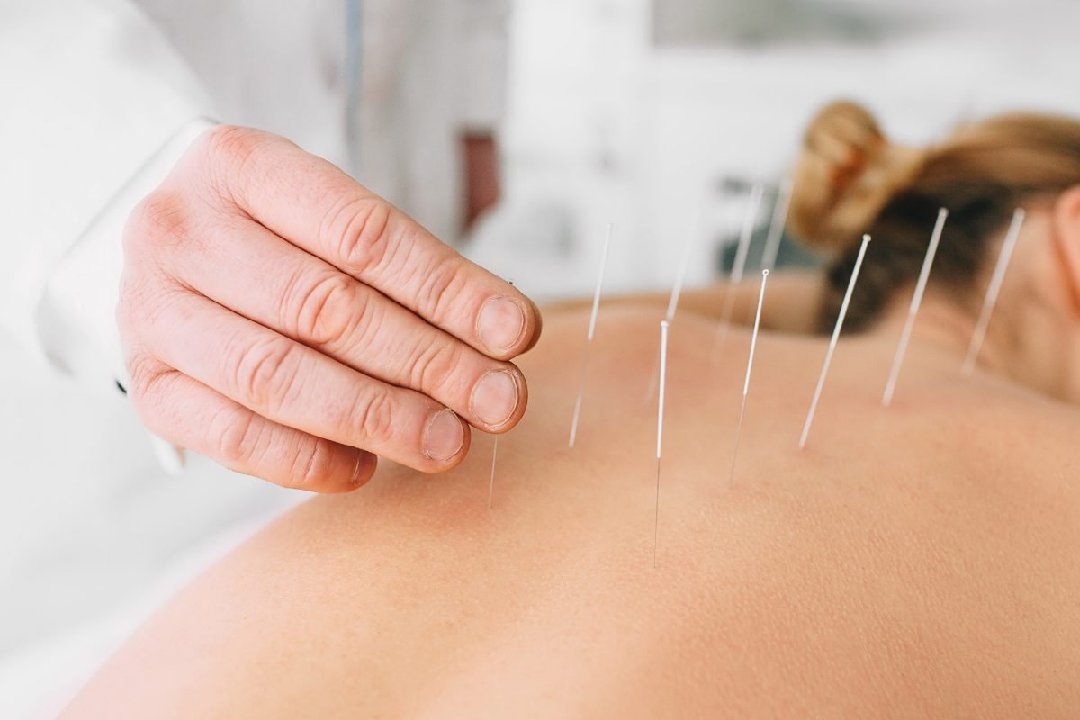Sessão de acupuntura com agulhas aplicadas nas costas