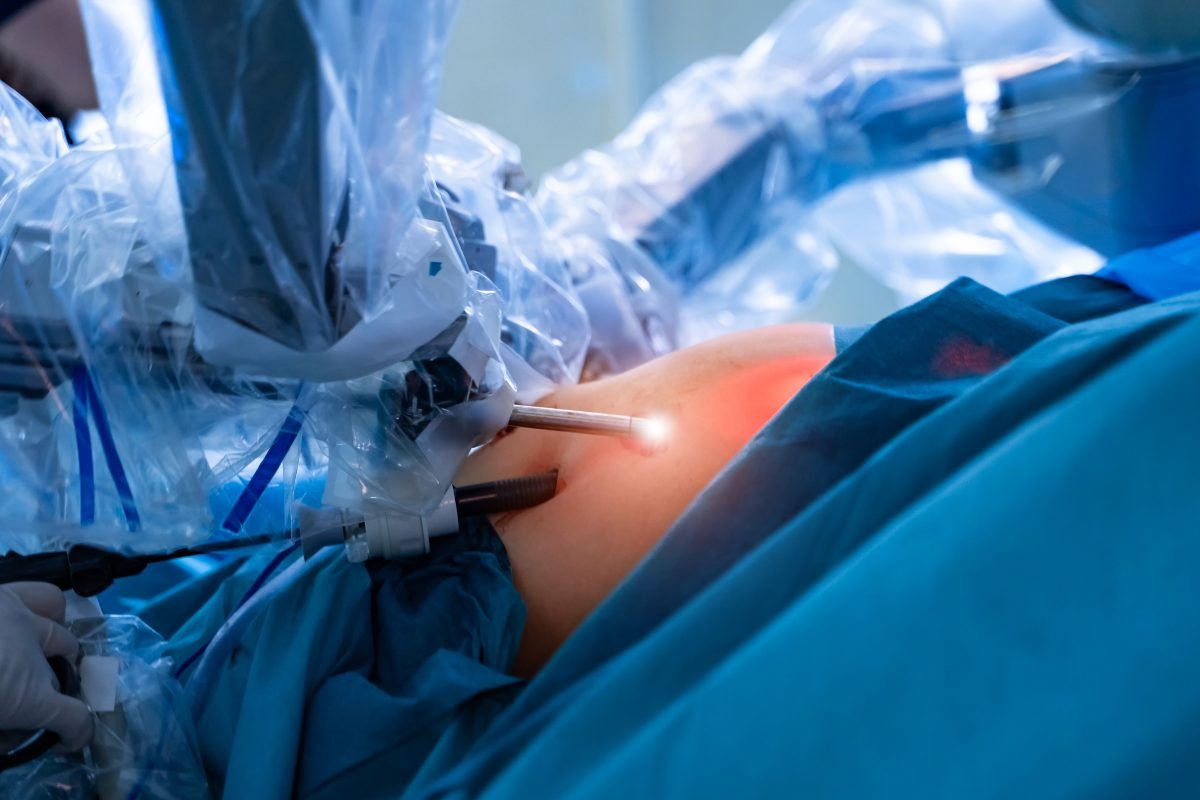Cirurgia bariátrica realizada por videolaparoscopia em centro cirúrgico